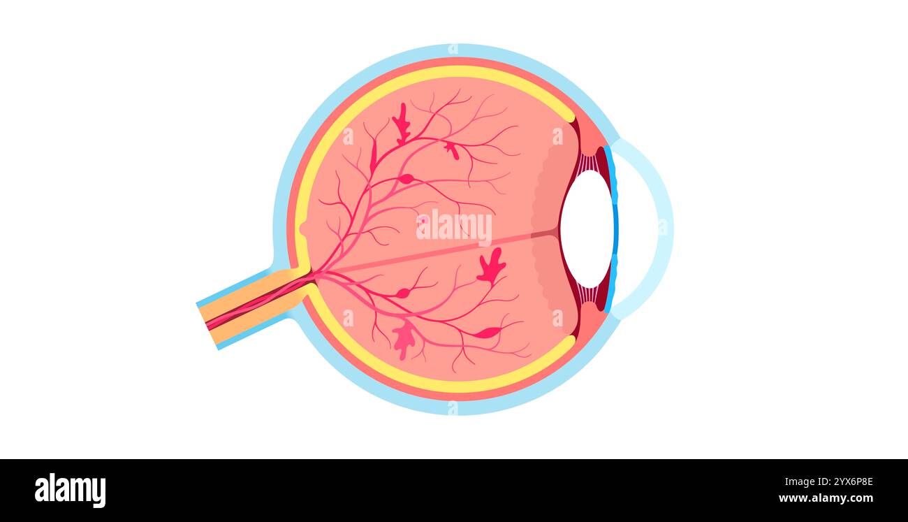 Diabetische Retinopathie, Illustration. Stockfoto