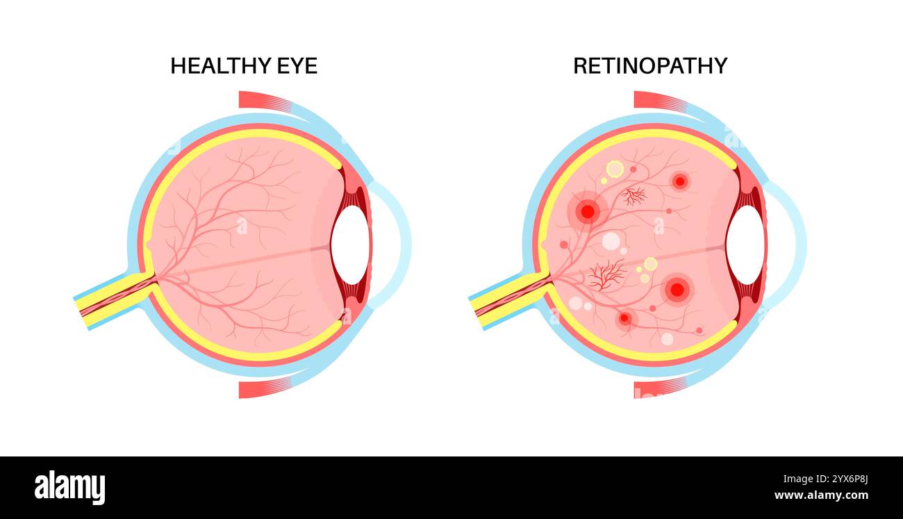 Diabetische Retinopathie, Illustration. Stockfoto