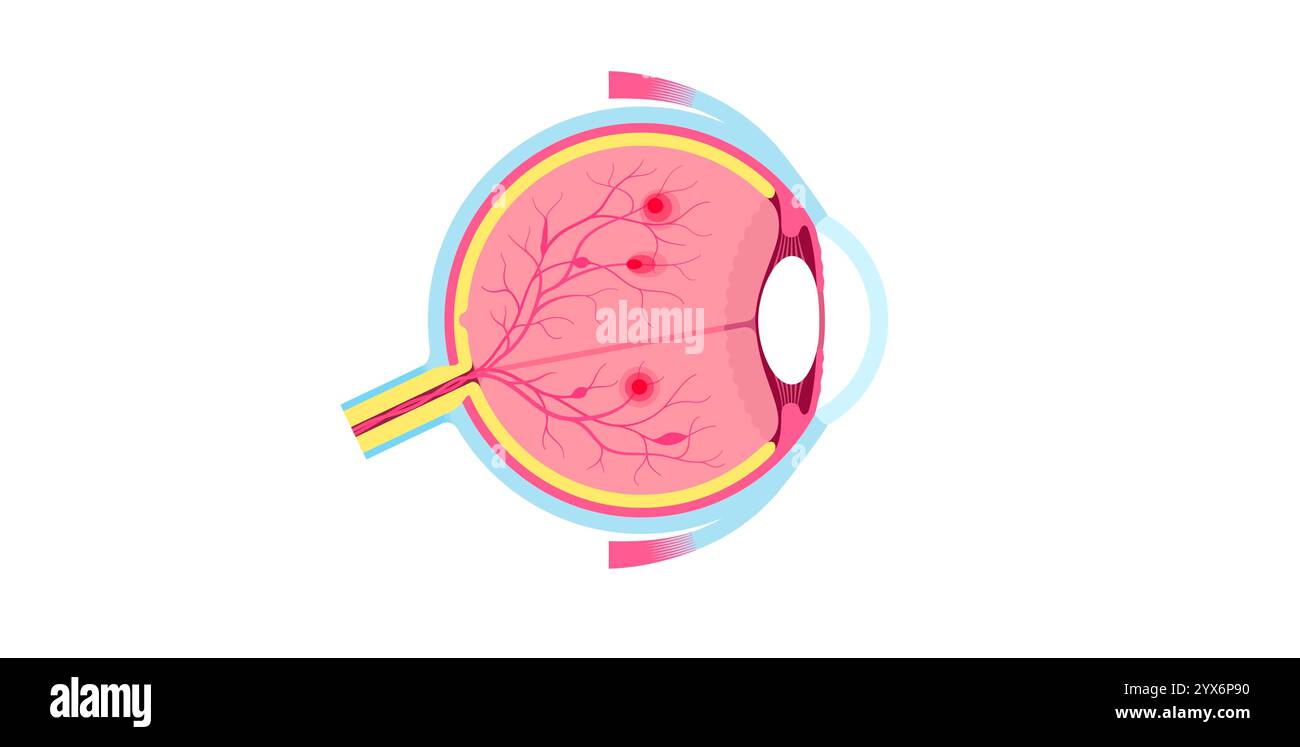 Diabetische Retinopathie, Illustration. Stockfoto