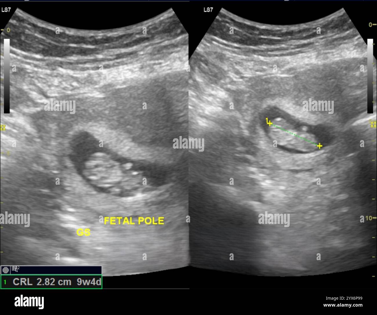 Ultraschallaufnahmen eines Uterus mit einem menschlichen Fötus nach 9 Wochen. In diesem Stadium misst der Fetus etwa 4 Zentimeter. Stockfoto