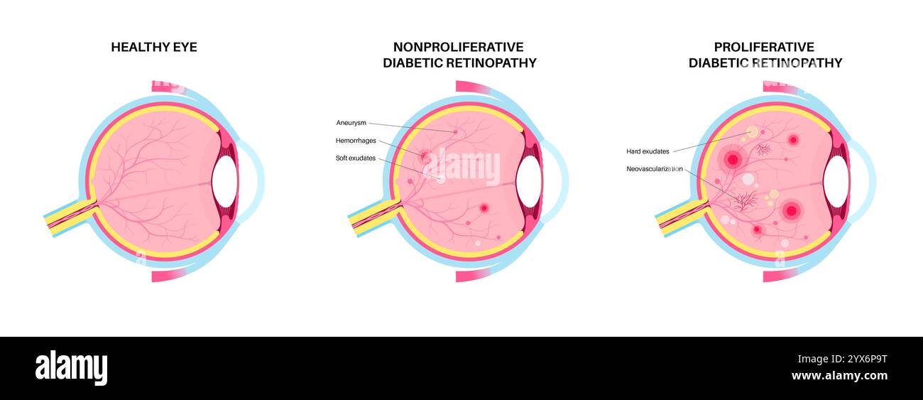 Diabetische Retinopathie, Illustration. Stockfoto