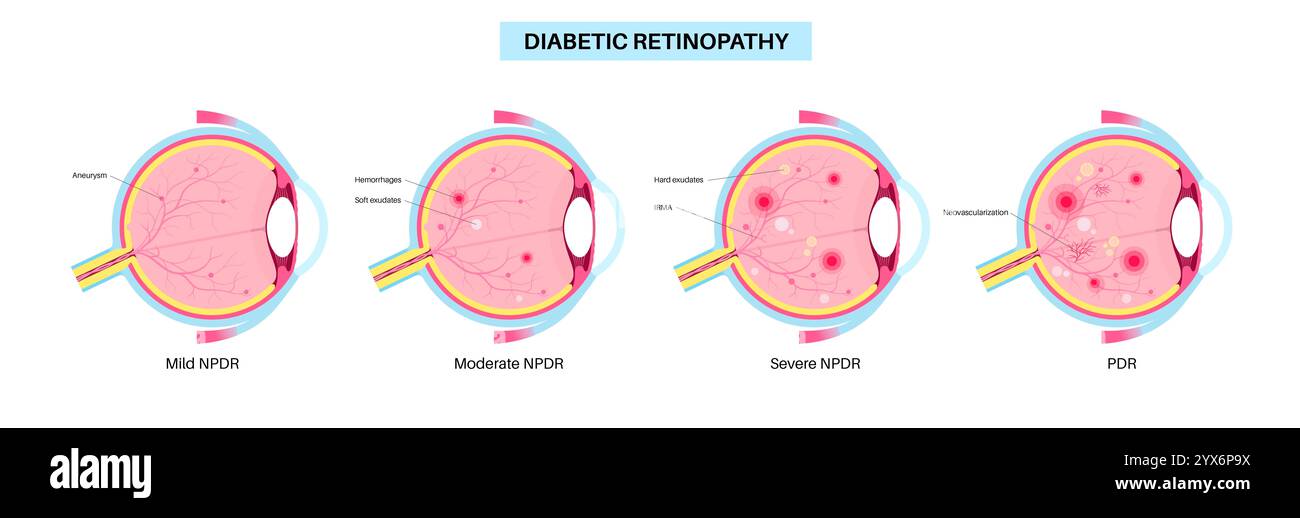 Diabetische Retinopathie, Illustration. Stockfoto