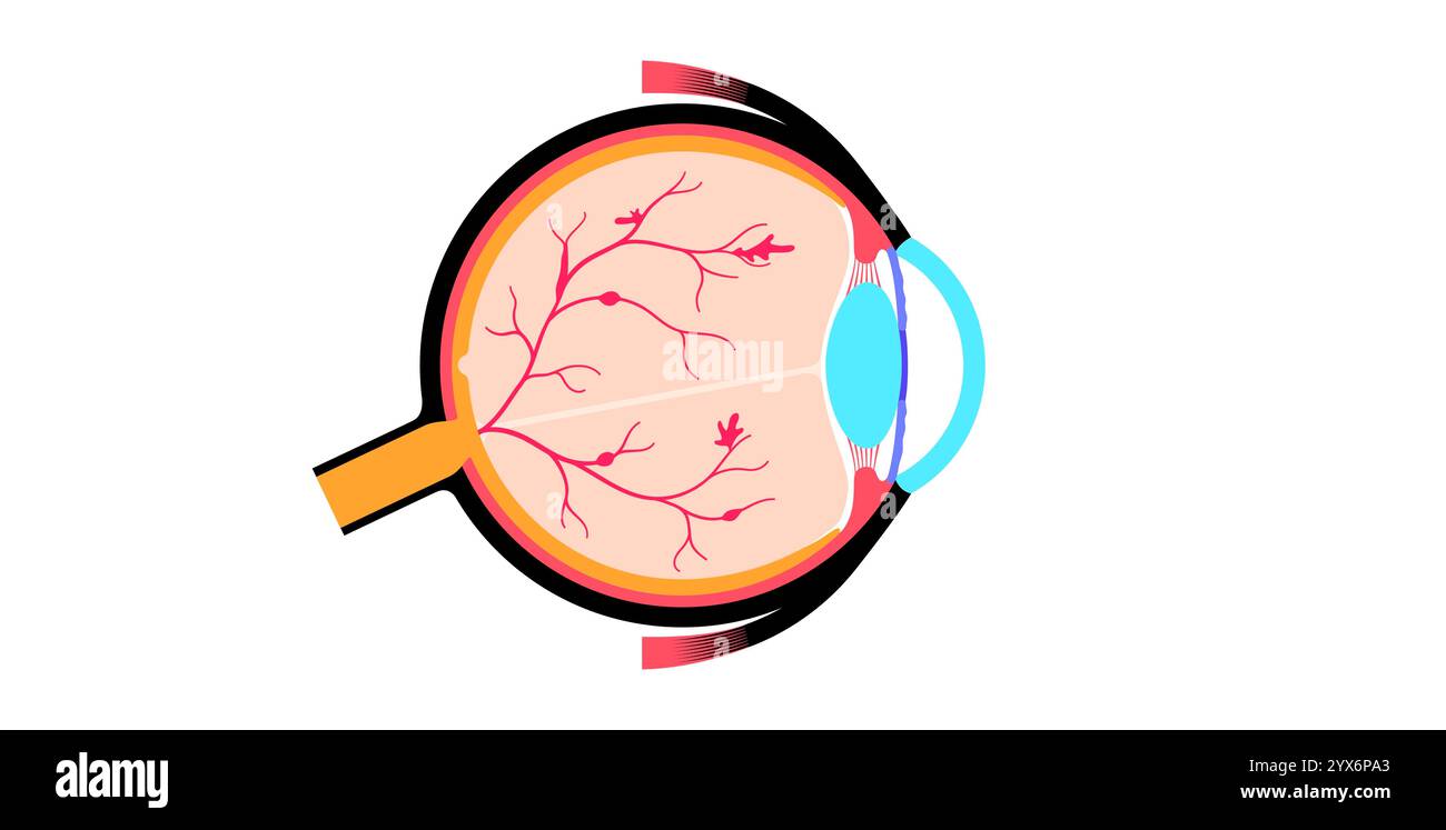 Diabetische Retinopathie, Illustration. Stockfoto