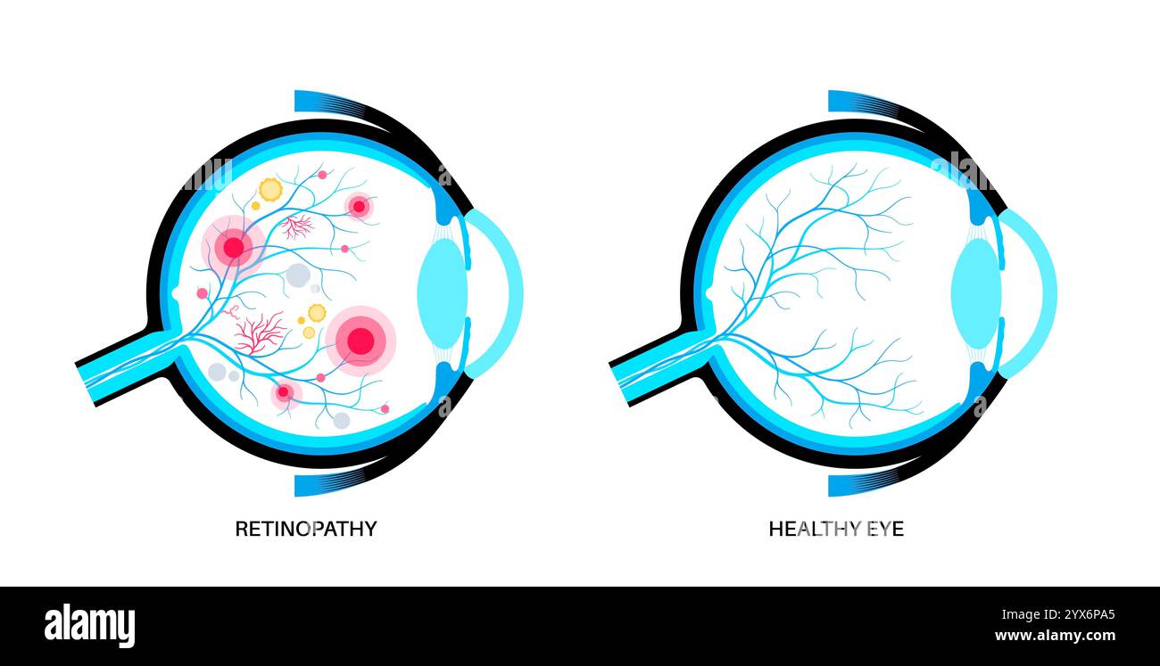 Diabetische Retinopathie, Illustration. Stockfoto