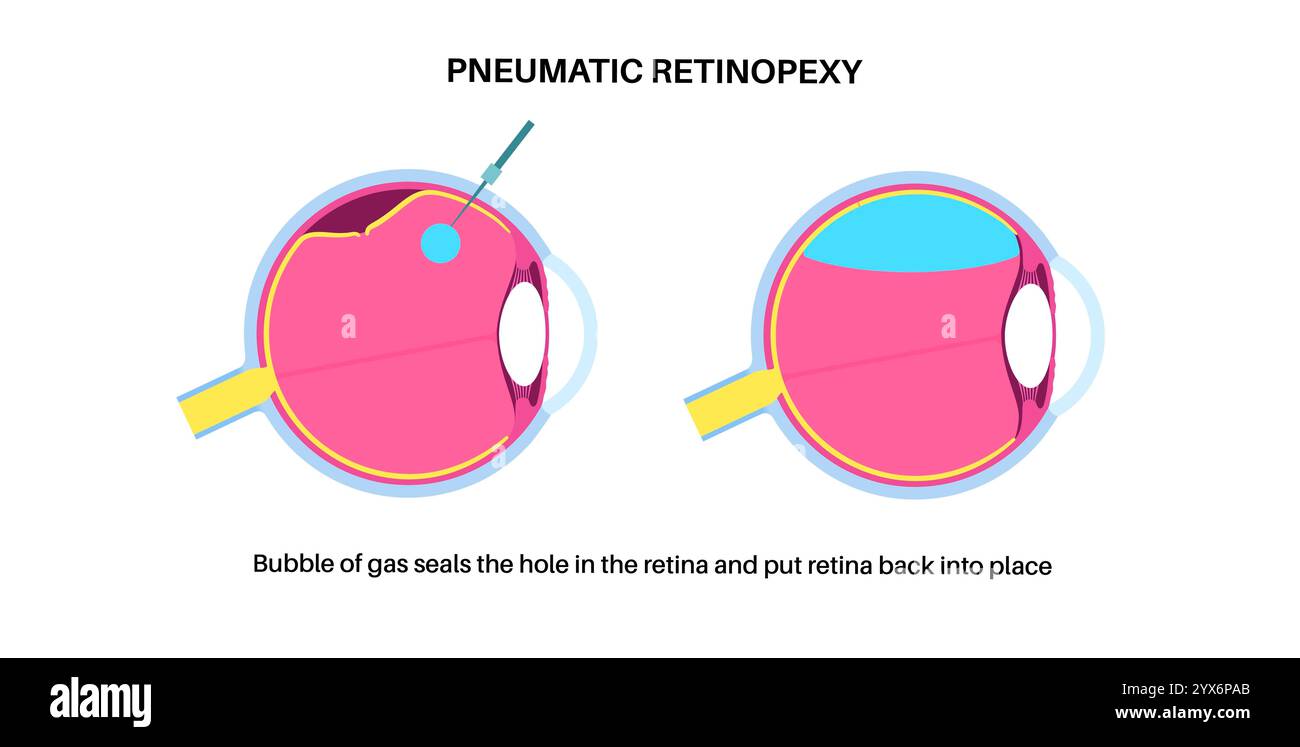 Pneumatische Retinopexie, Abbildung. Dies ist ein minimalinvasives Augenverfahren zur Reparatur einer Netzhautablösung. Dabei wird eine Gasblase in den Glaskörper injiziert, um die Netzhaut wieder anzubringen, kombiniert mit Laser- oder Kryotherapie Stockfoto