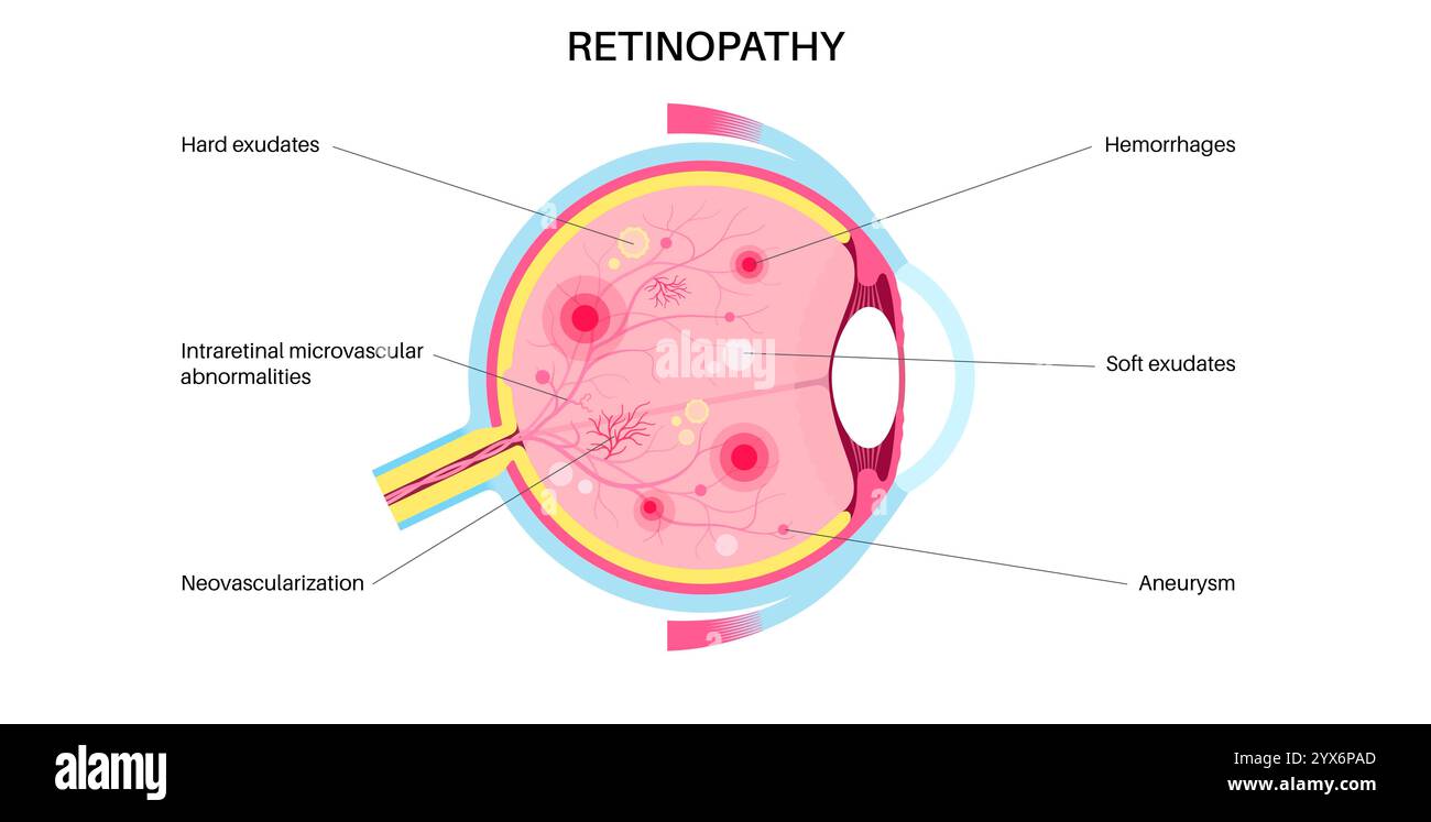 Diabetische Retinopathie, Illustration. Stockfoto