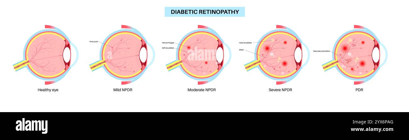 Diabetische Retinopathie, Illustration. Stockfoto