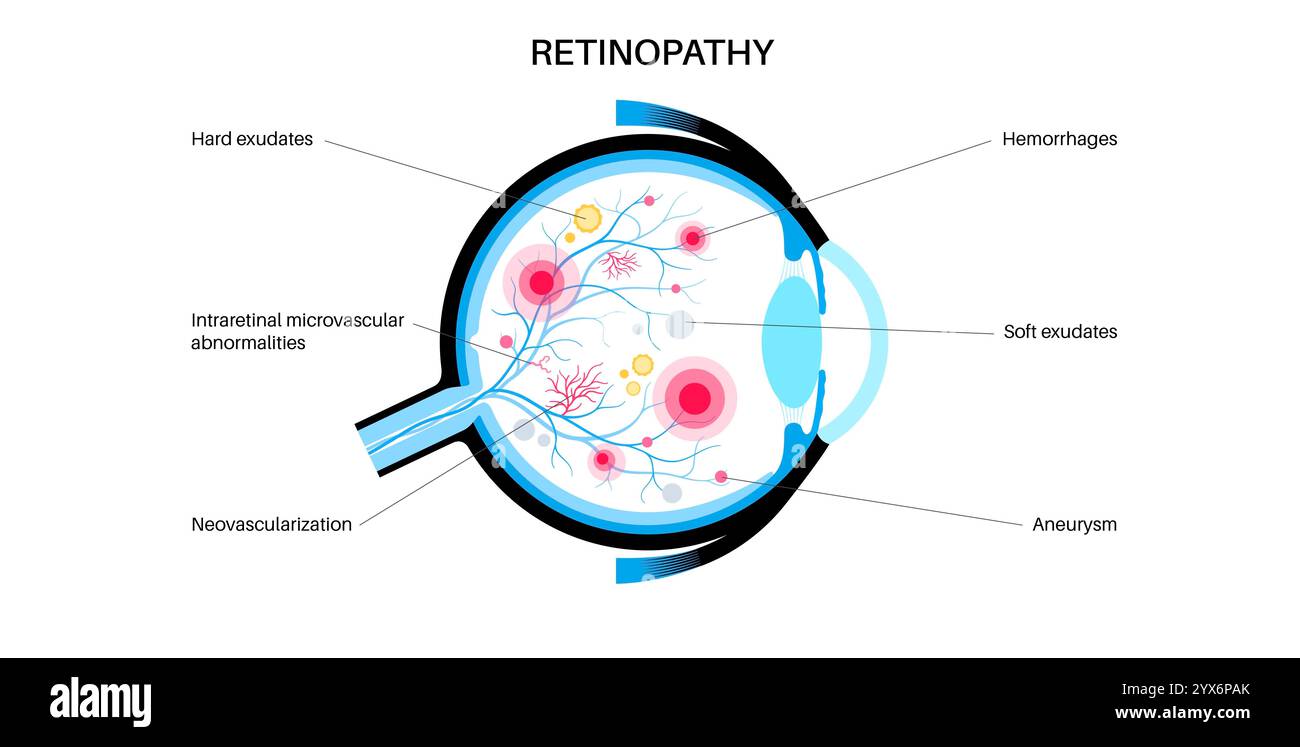 Diabetische Retinopathie, Illustration. Stockfoto