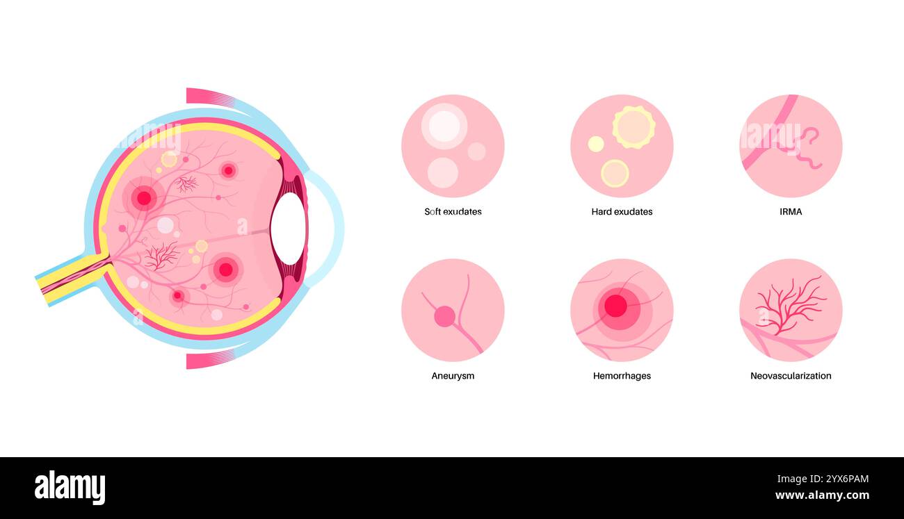 Diabetische Retinopathie, Illustration. Stockfoto