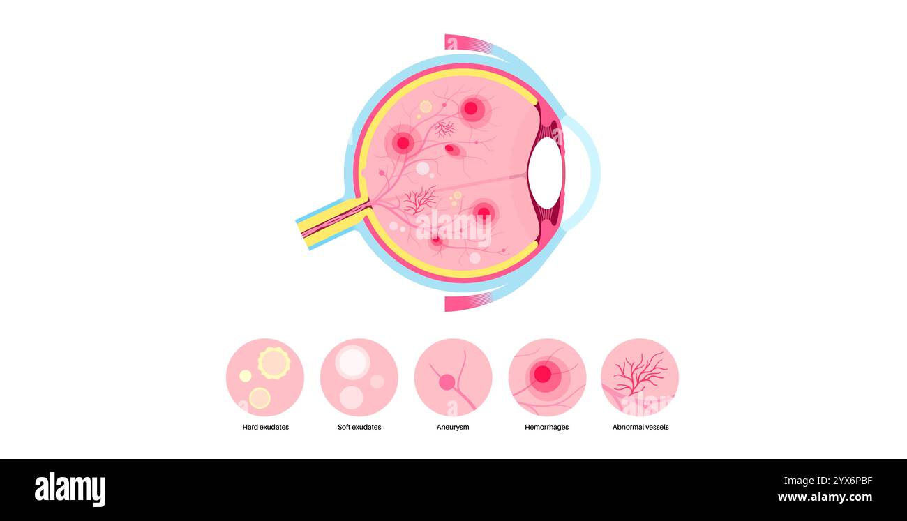 Diabetische Retinopathie, Illustration. Stockfoto