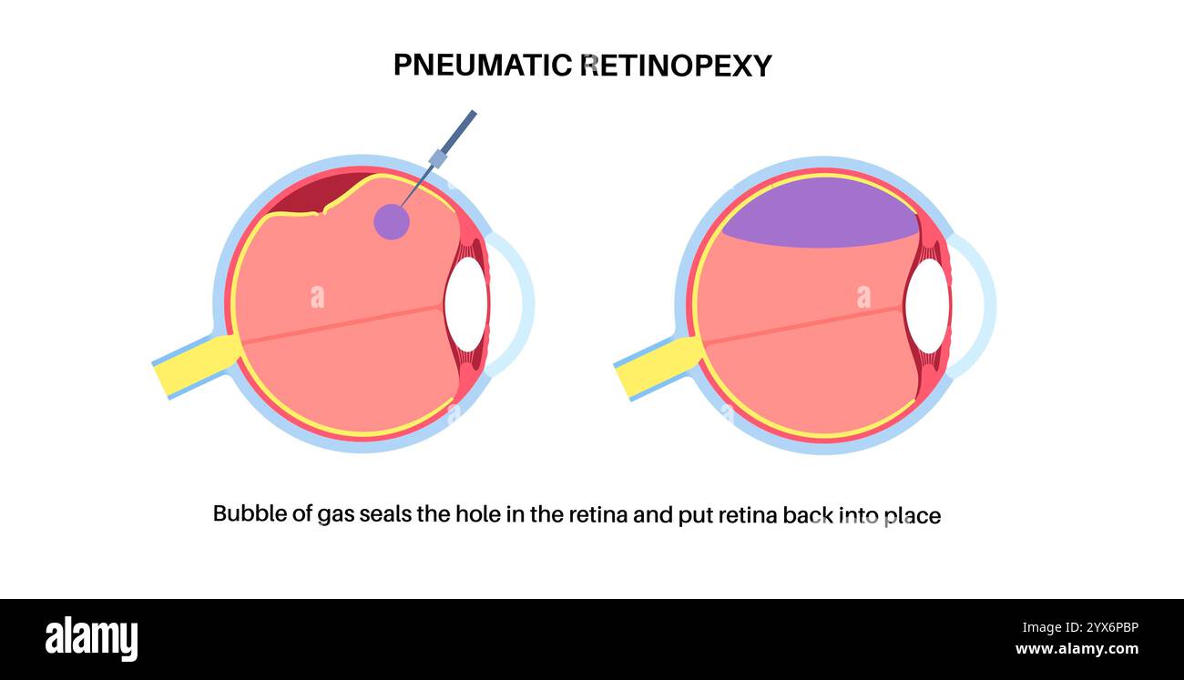 Pneumatische Retinopexie, Abbildung. Dies ist ein minimalinvasives Augenverfahren zur Reparatur einer Netzhautablösung. Dabei wird eine Gasblase in den Glaskörper injiziert, um die Netzhaut wieder anzubringen, kombiniert mit Laser- oder Kryotherapie Stockfoto