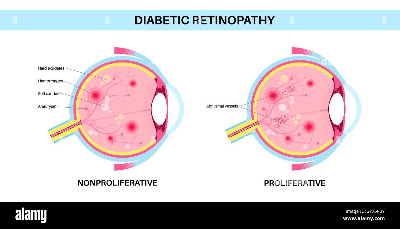 Diabetische Retinopathie, Illustration. Stockfoto