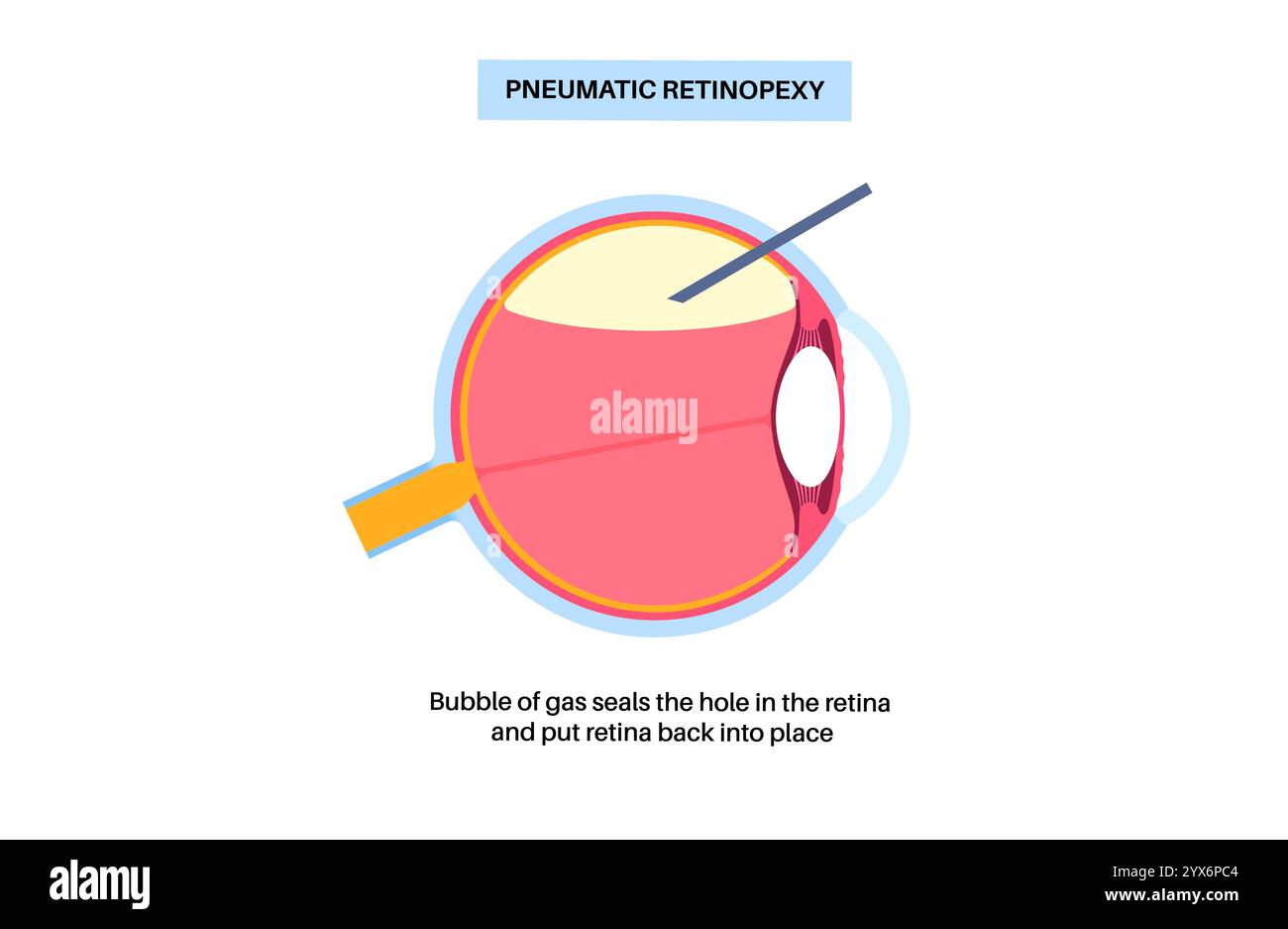 Pneumatische Retinopexie, Abbildung. Dies ist ein minimalinvasives Augenverfahren zur Reparatur einer Netzhautablösung. Dabei wird eine Gasblase in den Glaskörper injiziert, um die Netzhaut wieder anzubringen, kombiniert mit Laser- oder Kryotherapie Stockfoto