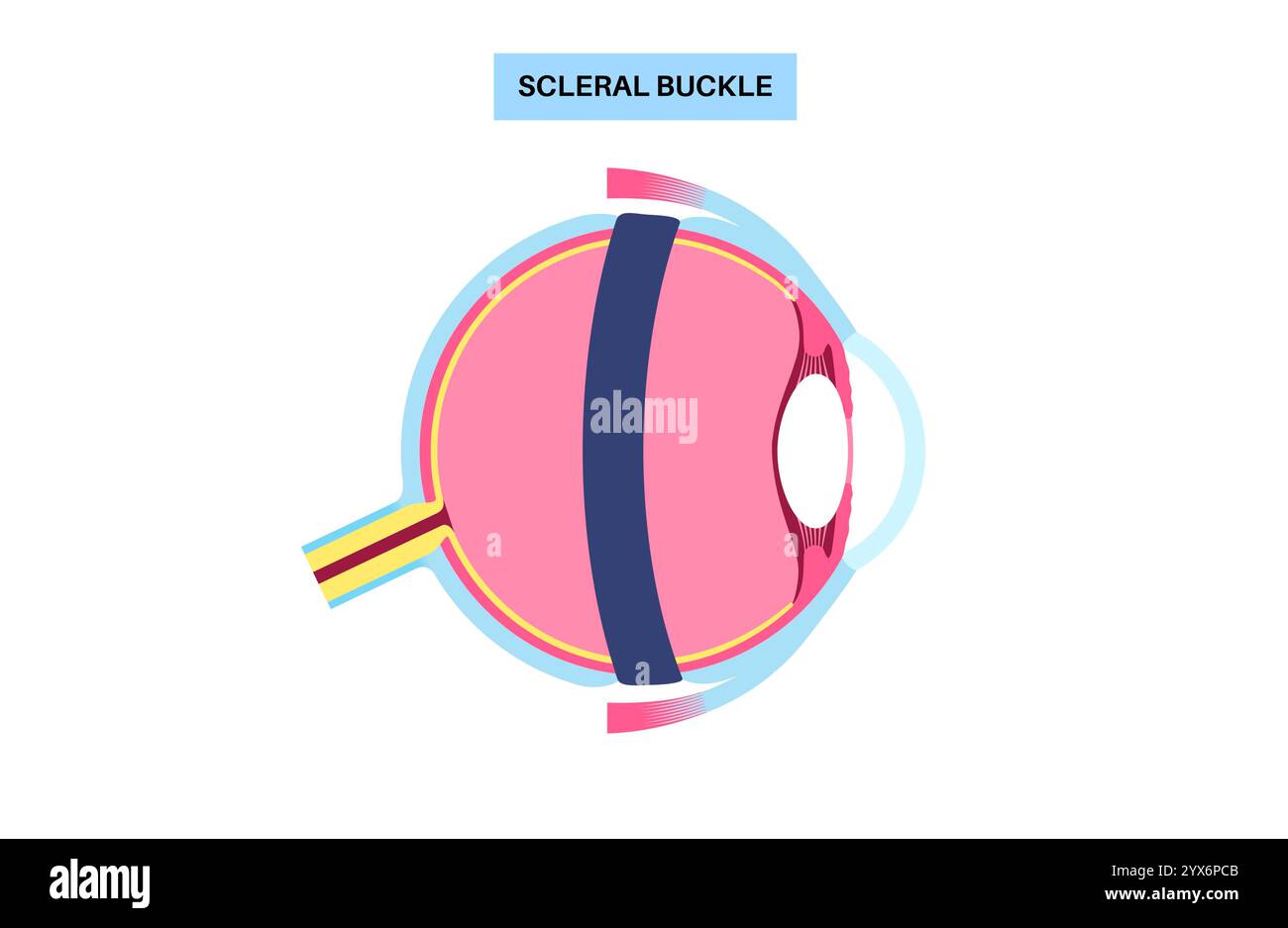 Das Skleralschnallverfahren, Illustration. Dies ist ein Verfahren zur Reparatur der Netzhautablösung, indem ein Silikonband um das Auge gelegt wird, um die Netzhauttraktion zu entlasten. Stockfoto