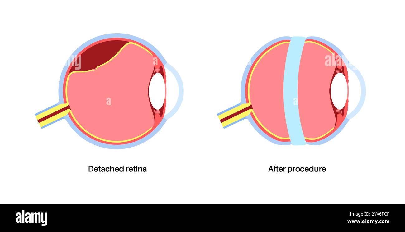Das Skleralschnallverfahren, Illustration. Dies ist ein Verfahren zur Reparatur der Netzhautablösung, indem ein Silikonband um das Auge gelegt wird, um die Netzhauttraktion zu entlasten. Stockfoto