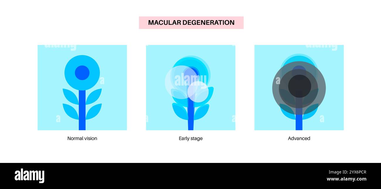 Makuladegeneration, Illustration. Stockfoto