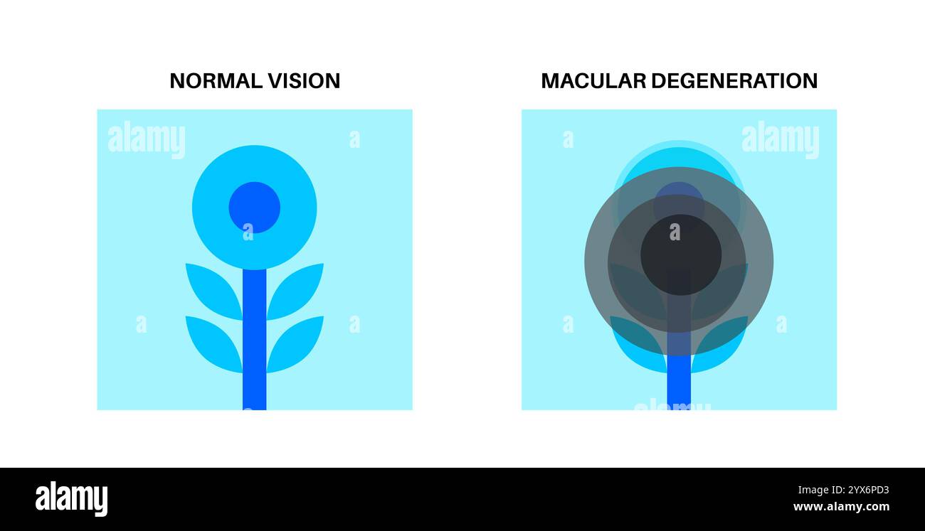 Makuladegeneration, Illustration. Stockfoto