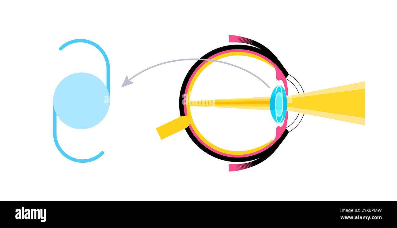 Intraokulare Linsenimplantation, Illustration. Stockfoto
