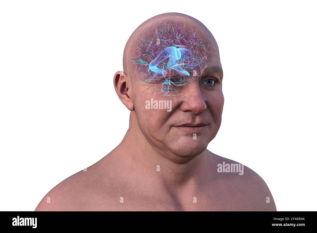 Computerdarstellung des menschlichen Gehirns mit orangefarbenem Aquädukt und grünem Ventrikelsystem, die den Liquorfluss (CSF) zeigen. Stockfoto