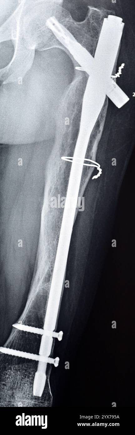 Röntgenaufnahme operativer Interferenz bei intramedullärer nageltransfisierender LT-Femurschaftfraktur mit ossifizierter Kallusbildung, interne Fixation Stockfoto