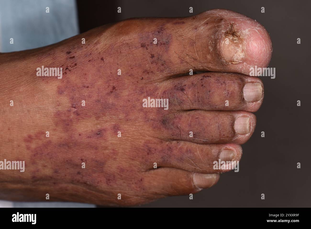 IgA (Immunglobulin A) Vaskulitis Ausschlag am Fuß einer 55-jährigen hispanischen Patientin. Früher bekannt als Henoch-Schonlein Purpura, ist dies die Entzündung und Blutung der Blutgefäße (Vaskulitis), die zu Hautausschlag und Gelenk- und Bauchschmerzen führt. Es handelt sich um eine seltene Erkrankung, die am häufigsten bei Kindern unter 10 Jahren auftritt. Selten kann es zu Nierenschäden führen. IgA-Vaskulitis scheint eine Autoimmunerkrankung zu sein, aber ihre Ursache ist unklar. Normalerweise wird es ohne Behandlung besser. Stockfoto
