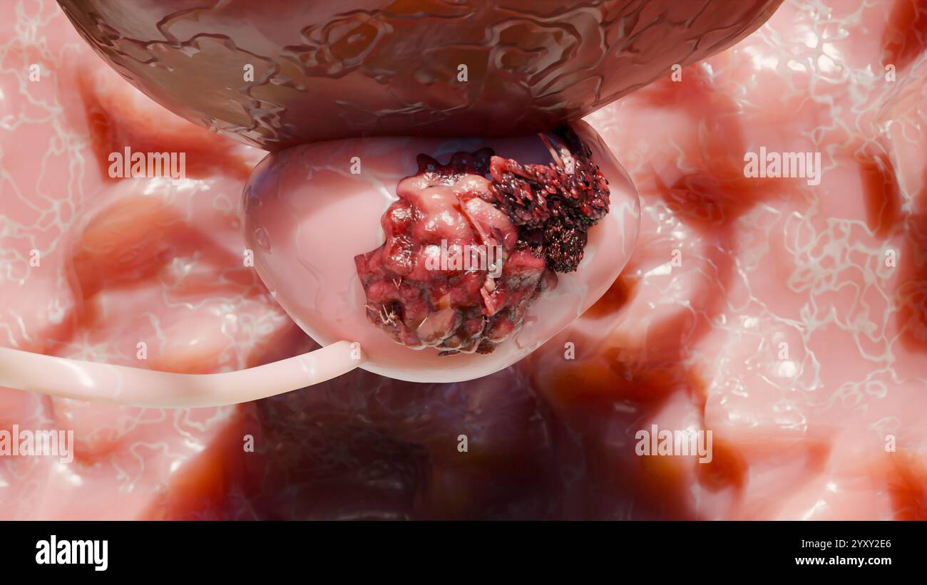 Prostatakarzinom-Stadien. Kanzeröse Zellen, bösartiger Tumor komprimiert die Harnröhre. Pathologische Störung, Genitalreproduktionssystem, Alphakanal, Bladd Stockfoto