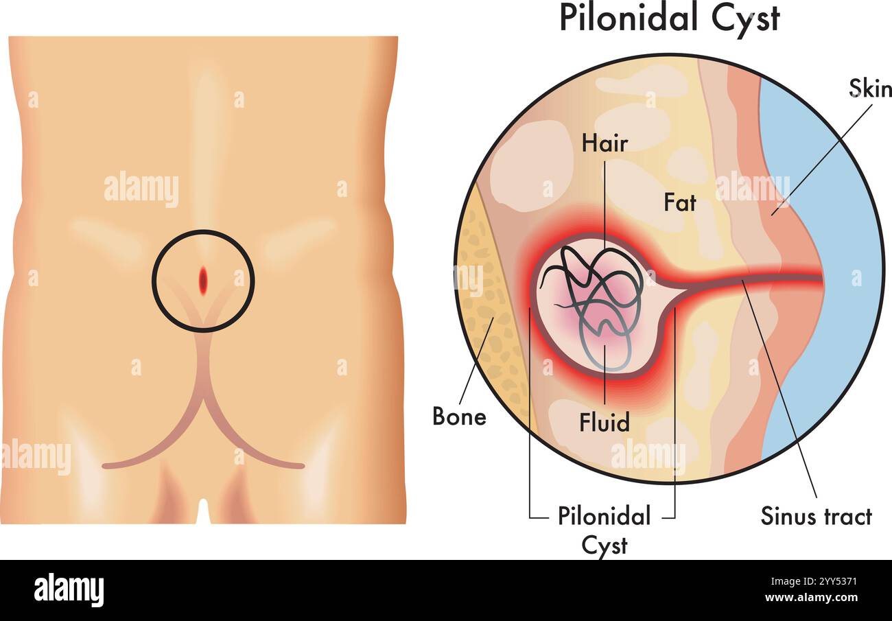 Medizinische Illustration der Pilonidalzyste mit Anmerkungen. Stock Vektor