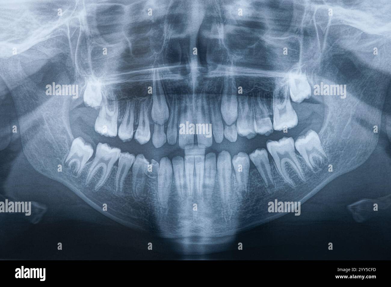 Panoramaaufnahme des Kiefers. Orthopantomographie, OPG-Röntgen-DR digitale Weisheitszähne. Panorama-Filmröntgenuntersuchung im Zahnarzt. Verrauschte Fotos. Röntgenaufnahme des Patienten-ja Stockfoto