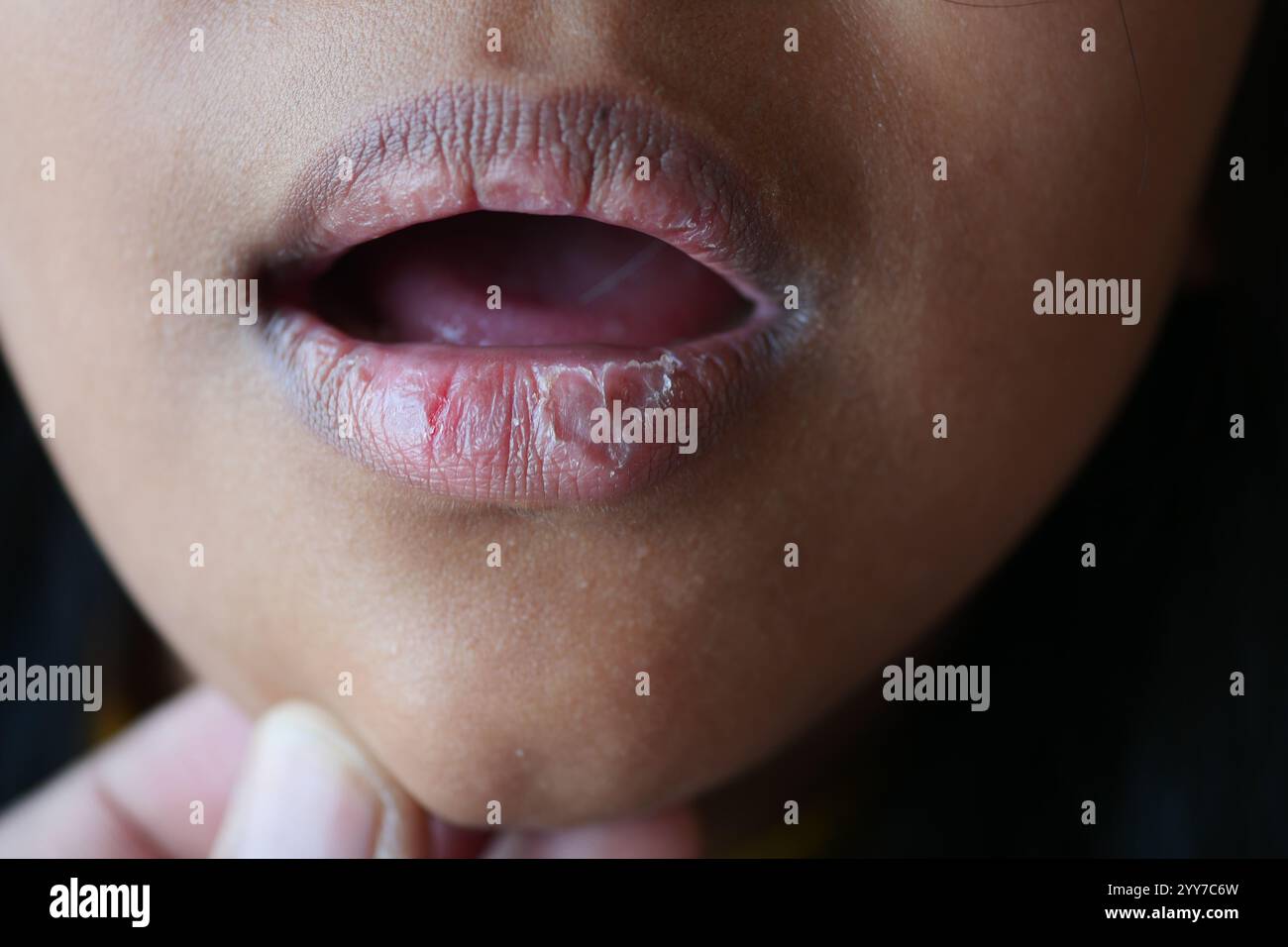 Nahaufnahme der trockenen Lippe eines Kindes Stockfoto