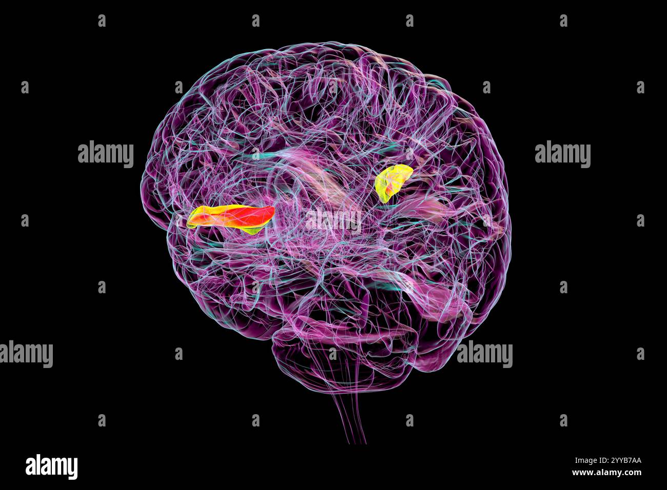 Computerdarstellung eines menschlichen Gehirns mit hervorgehobener transversaler temporaler Gyri, anterior grün und posterior orange. Diese Regionen sind inv Stockfoto