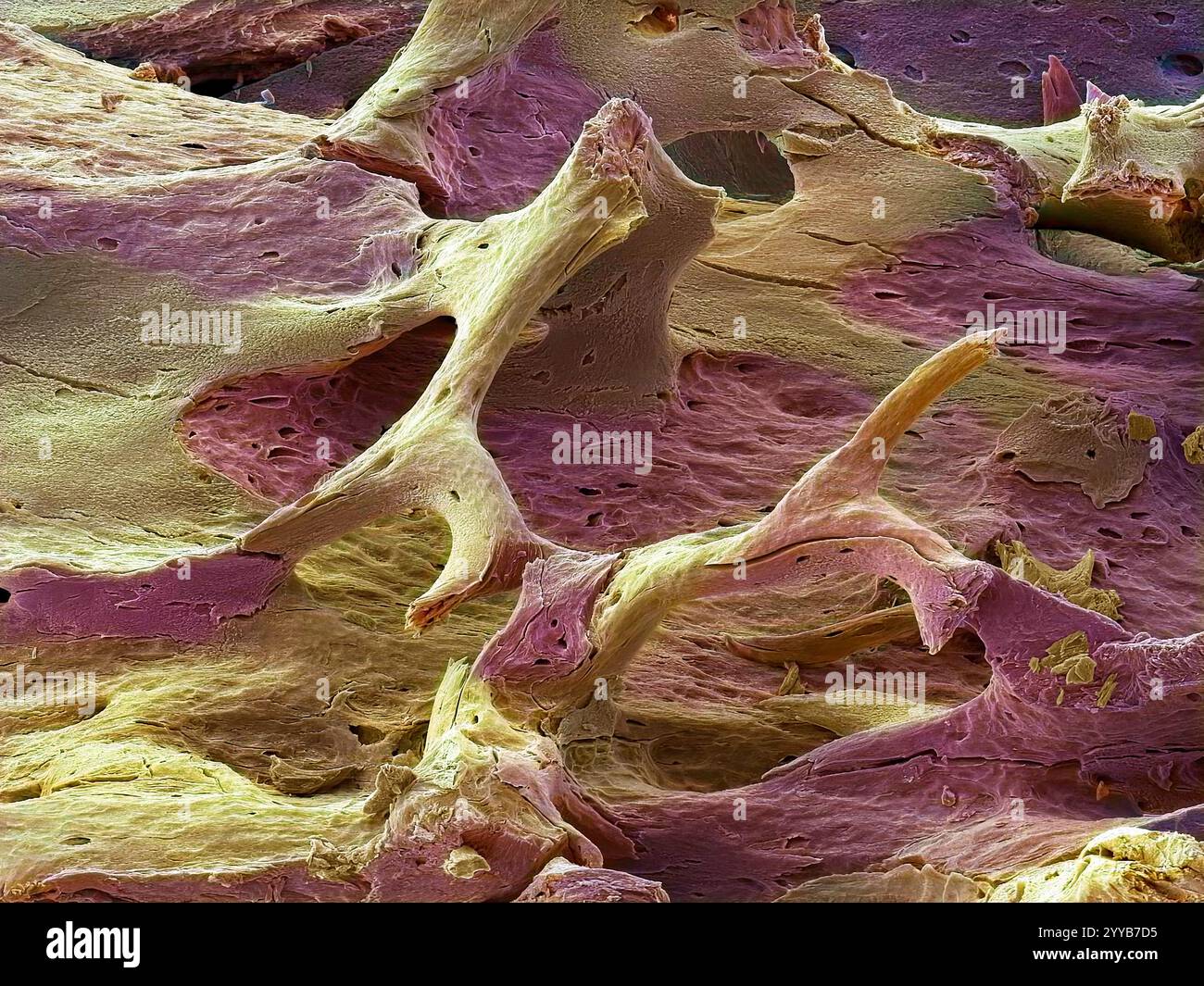 Osteoporotischer Knochen. Farbige Rasterelektronenmikrographie (REM) des Osteoporose-befallenen Knochens. Osteoporose ist eine Erkrankung der Knochen, die zu einer Verringerung der Dichte und einer Zunahme der Porosität führt, was zu einer erhöhten Brüchigkeit und einem erhöhten Frakturrisiko führt. Es betrifft häufig postmenopausale Frauen, bei denen die Spiegel des Hormons Östrogen absinken. Es kann sich auch nach einer Verletzung oder Infektion entwickeln. Östrogenersatzstoffe und Medikamente, die den Knochenabbau verlangsamen, werden zur Behandlung der Krankheit verwendet. Vergrößerung: x65, wenn 10 Zentimeter breit gedruckt wird. Stockfoto