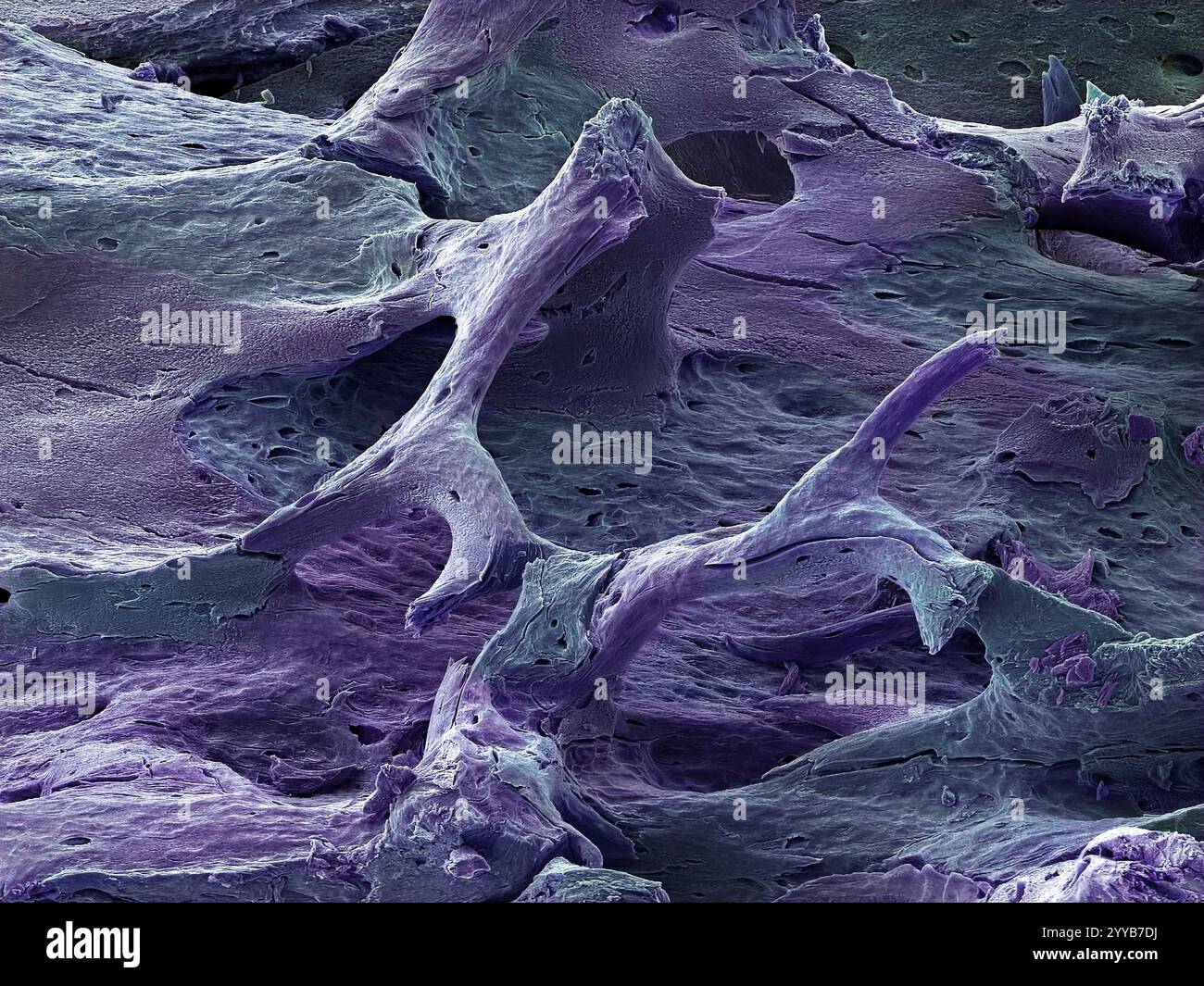 Osteoporotischer Knochen. Farbige Rasterelektronenmikrographie (REM) des Osteoporose-befallenen Knochens. Osteoporose ist eine Erkrankung der Knochen, die zu einer Verringerung der Dichte und einer Zunahme der Porosität führt, was zu einer erhöhten Brüchigkeit und einem erhöhten Frakturrisiko führt. Es betrifft häufig postmenopausale Frauen, bei denen die Spiegel des Hormons Östrogen absinken. Es kann sich auch nach einer Verletzung oder Infektion entwickeln. Östrogenersatzstoffe und Medikamente, die den Knochenabbau verlangsamen, werden zur Behandlung der Krankheit verwendet. Vergrößerung: x65, wenn 10 Zentimeter breit gedruckt wird. Stockfoto