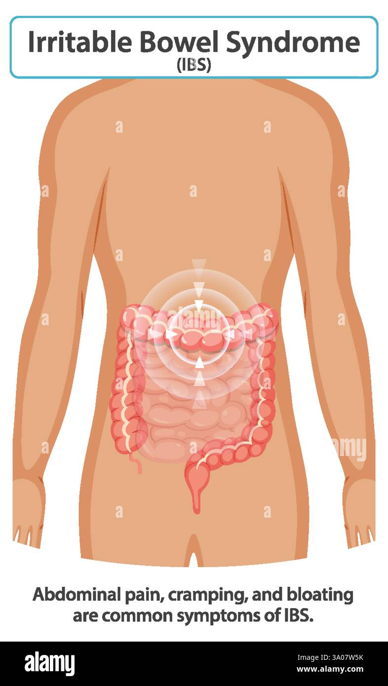 Abbildung der Symptome des RDS und der betroffenen Bereiche Stock Vektor