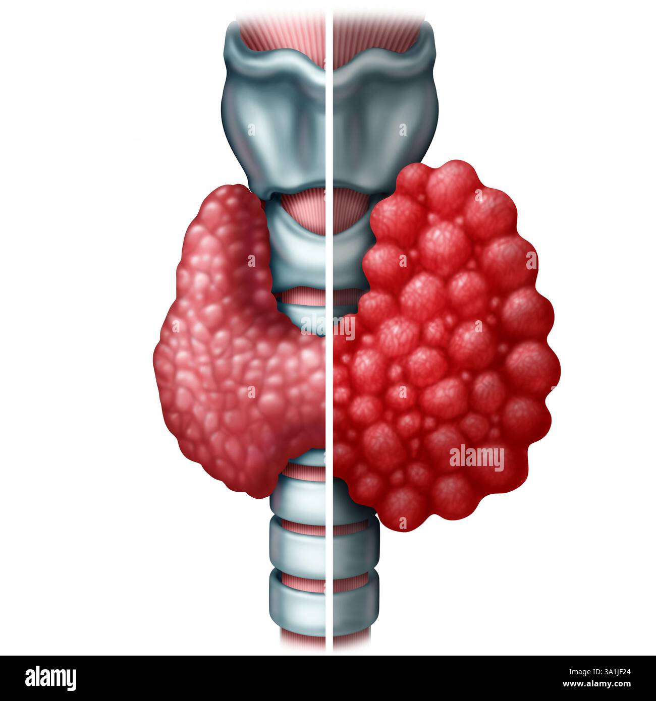 Hypothyreose als Schilddrüse, die nicht genügend Hormone produziert als menschliches organmedizinisches Illustrationskonzept mit Luftröhre und Kehlkopf als Sym Stockfoto