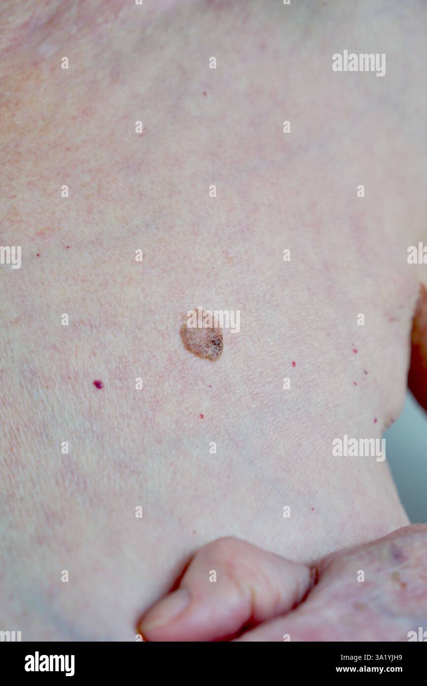 Muttermale und Hautkrebs versteckte Gefahren auf der Haut älterer Frauen. Hochwertige Fotos Stockfoto