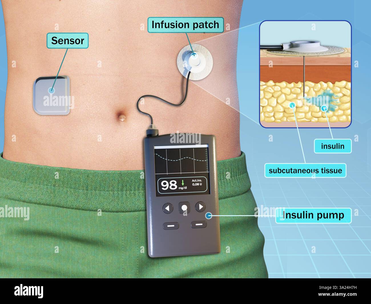 Insulinpumpe und drahtloser Glukosesensor für Diabetiker. Digitale Illustration, 3D-Rendering. Stockfoto