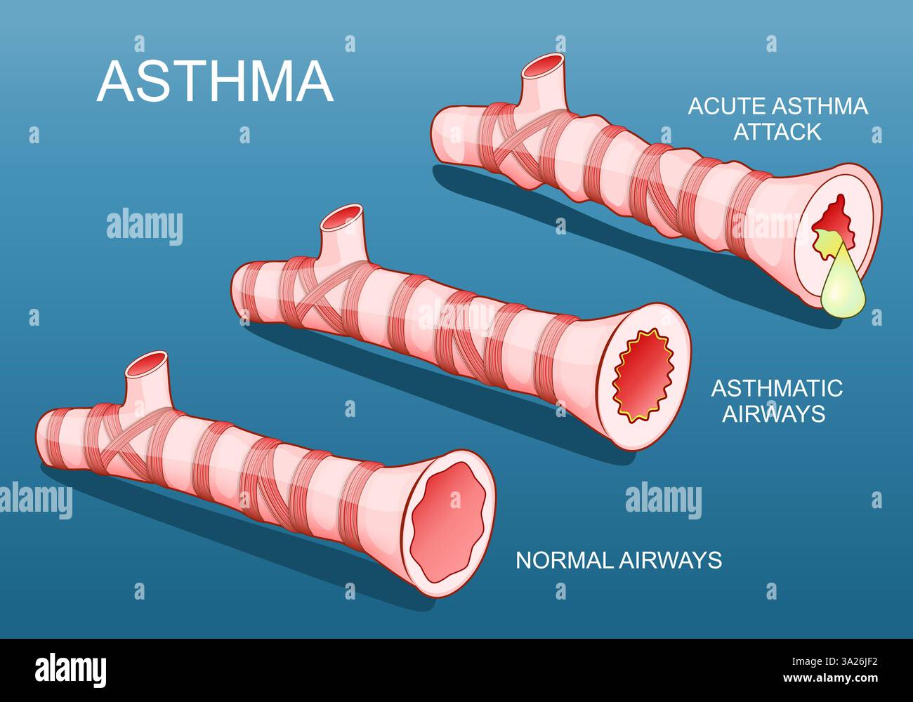 Asthma. Entzündliche Erkrankungen der Atemwege der Lunge. Normale Bronchiolen und Bronchiolen während eines Asthmaanfalls, wenn die Atemwege anschwellen und voll sind Stock Vektor