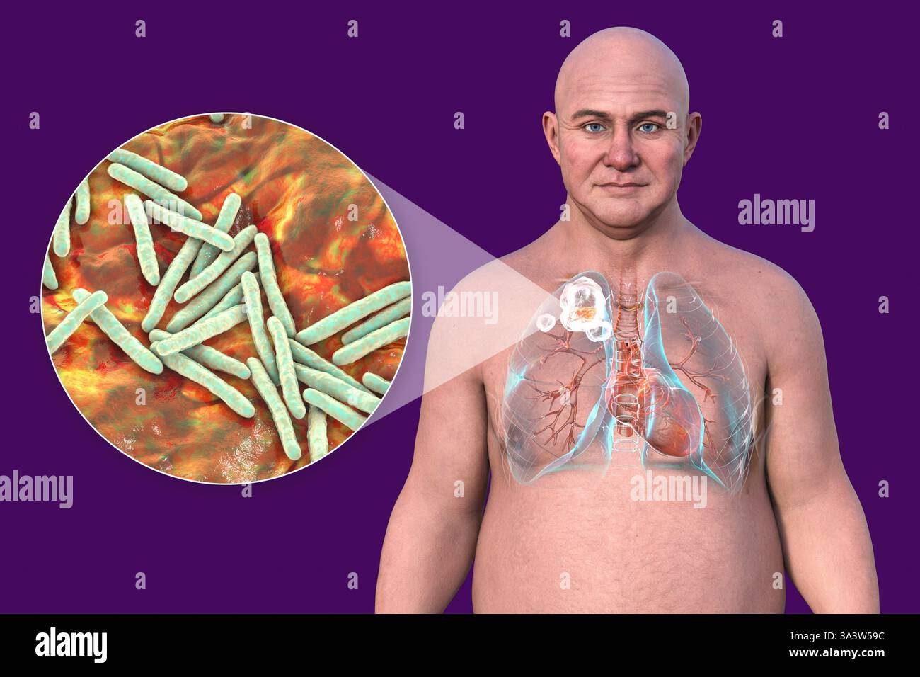 Illustration eines Mannes mit Lungen, die von Kavituberkulose im rechten Oberlappen betroffen sind, mit Lungenschäden und -Hohlräumen sowie Nahaufnahme von Mycobacterium tuberculosis-Bakterien. Stockfoto