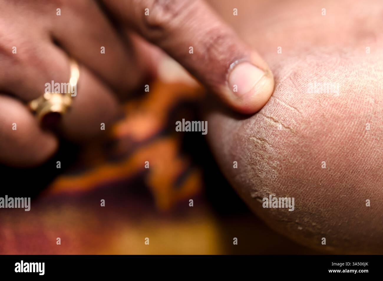 Nahaufnahme einer Hand, die auf eine gerissene Ferse zeigt, wie trockene Haut und die tägliche Fußpflege in der häuslichen Umgebung zu sehen sind. Stockfoto