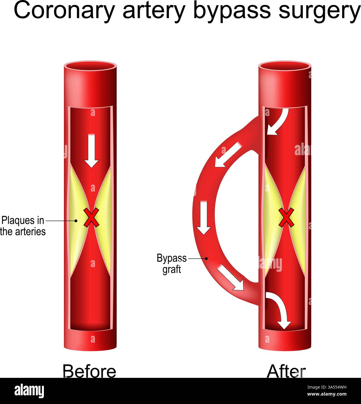 Koronararterien-Bypass-Transplantat. Herzchirurgie. Querschnitt der Arteriosklerose mit Plaques. Blockierter Blutfluss. Medizinisches Diagramm. Vektorillustr Stock Vektor
