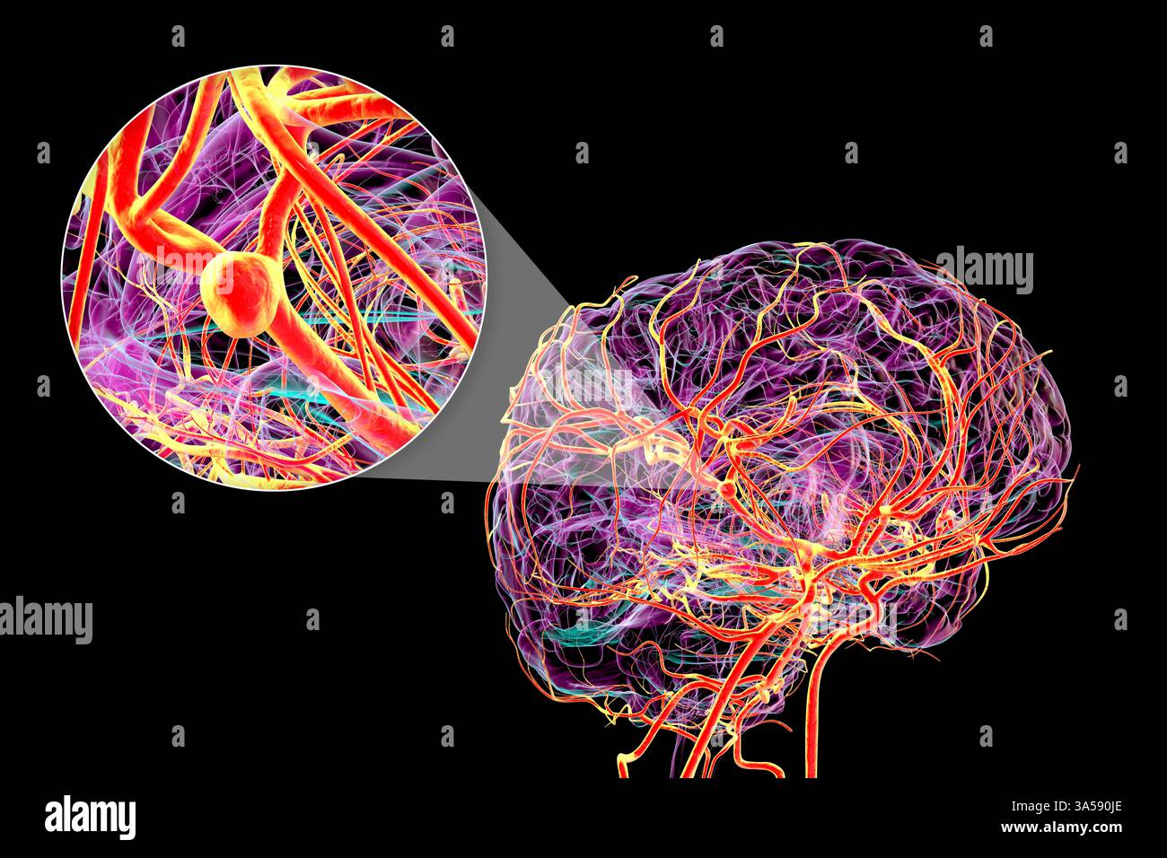 Darstellung eines sakkulären (Beeren-)Aneurysmas an der Arteria cerebri Media. Stockfoto