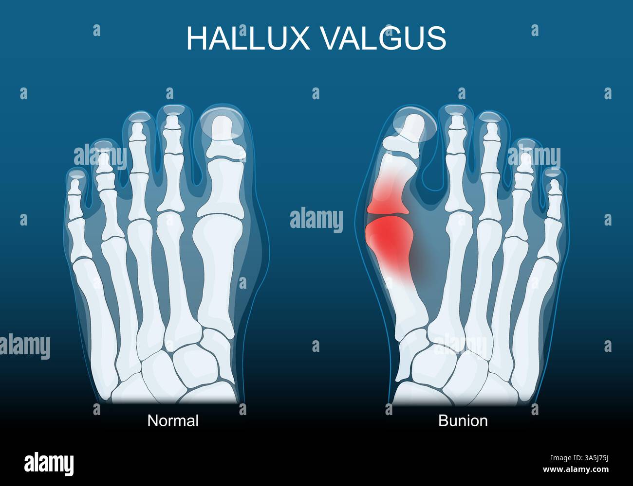 Bunion. Hallux valgus. Fussdeformität. Fehlausrichtung der Großzehe. Medizinisches Diagramm. Vektorabbildung Stock Vektor