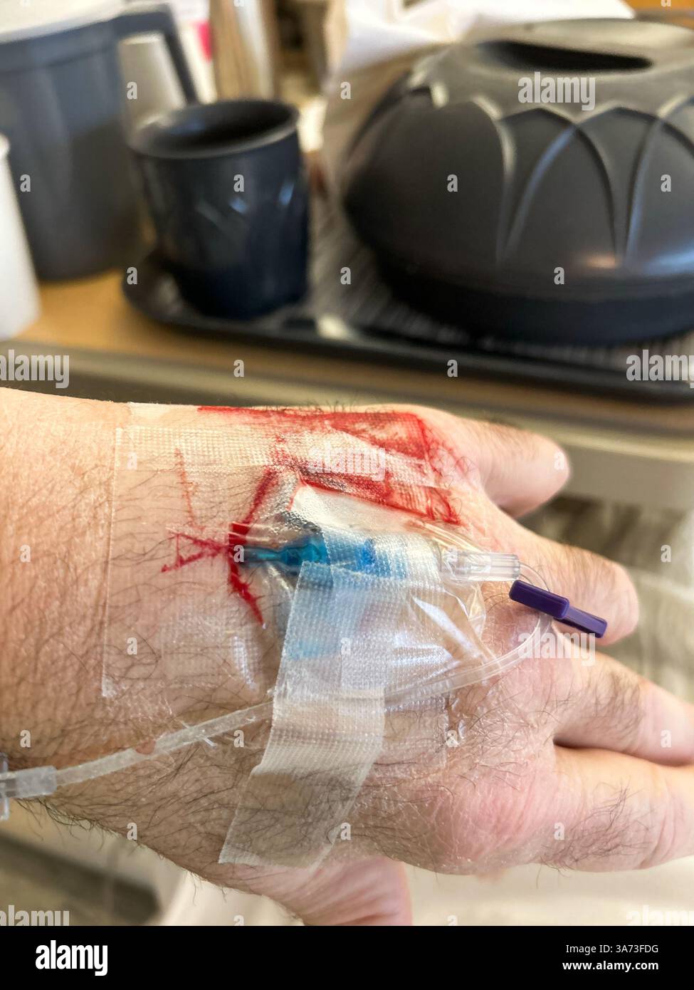 Infiltrierte IV in der Hand mit Blutrückgewinnung. Patientensicherheitskonzept. Stockfoto