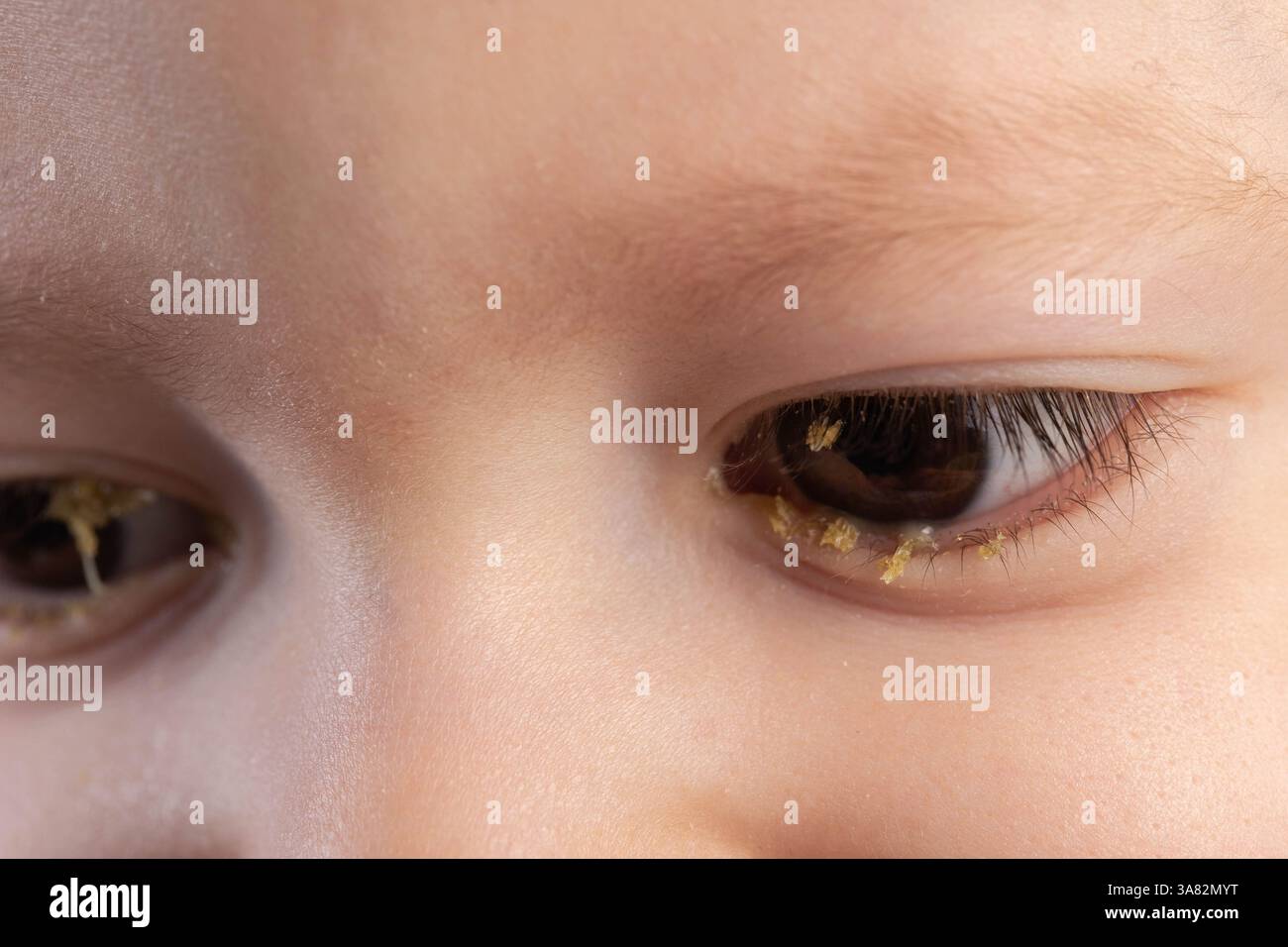 Bakterielle Infektion in den Augen eines kleinen Jungen, Bindehautentzündung, Eiter in den Augen. Stockfoto