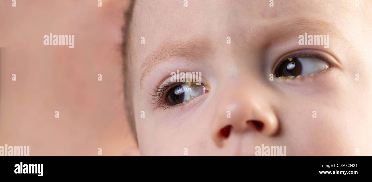 Kleiner Junge mit Eiter in den Augen, die Krankheit des Jungen ist bakterielle Bindehautentzündung. Virusinfektion der Augen. Stockfoto