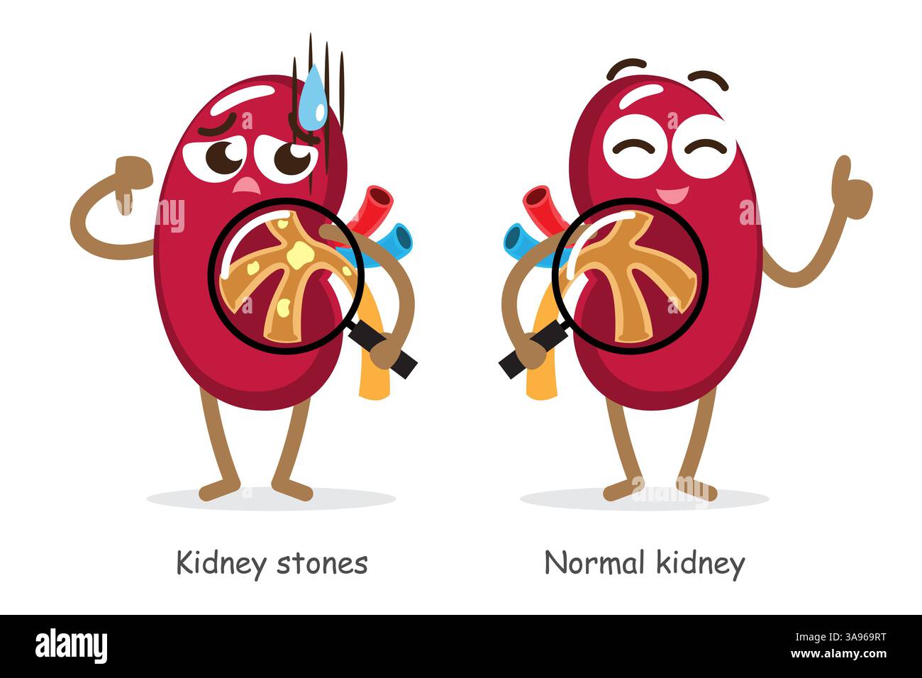 Nierensteine und normale Niere. Lustige Cartoonfiguren der medizinischen Nieren. Isolierter weißer Hintergrund. Vektor . Stock Vektor