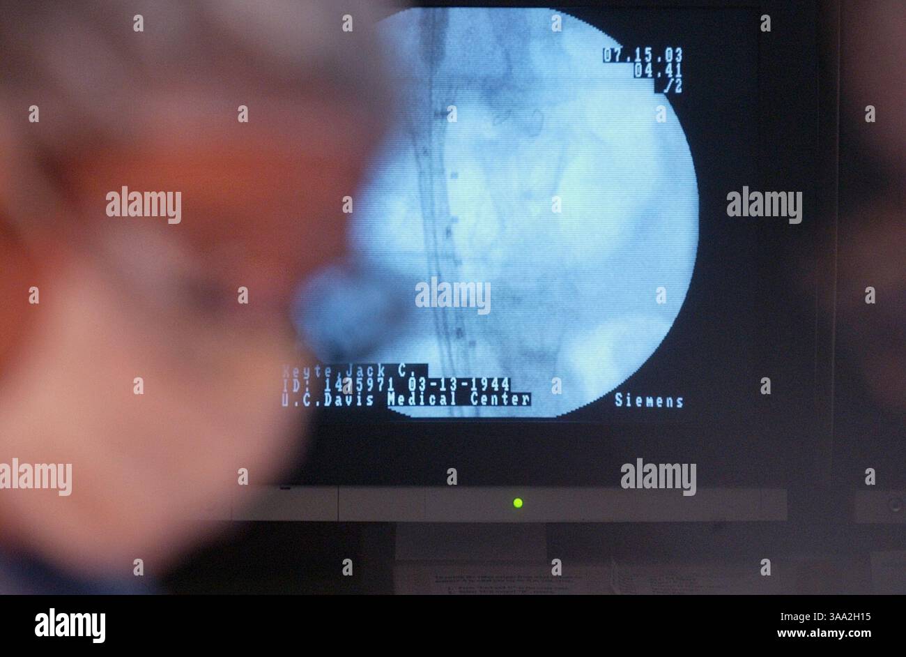 Dr. Bill Pevec, Mitglied des UC Davis Medical Center für vaskuläre Chirurgie, arbeitet an einem abdominalen Aortenaneurismus im Vorderklang mit einem Monitor, der die Röntgenführung für die STEM graf Operation zeigt, ist im Hintergrund, Dienstag, 15. Juli 2003, im Krankenhaus. Manny Crisostomo / Sacramento Bee /ZUMA Press Stockfoto