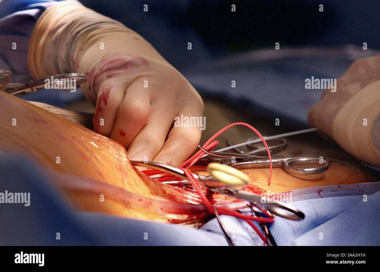 Dr. Bill Pevec, Mitglied des UC Davis Medical Center für Gefäßchirurgie, arbeitet am Dienstag, den 15. Juli 2003, im Krankenhaus an einem Aortenaneurismus. Manny Crisostomo / Sacramento Bee /ZUMA Press Stockfoto