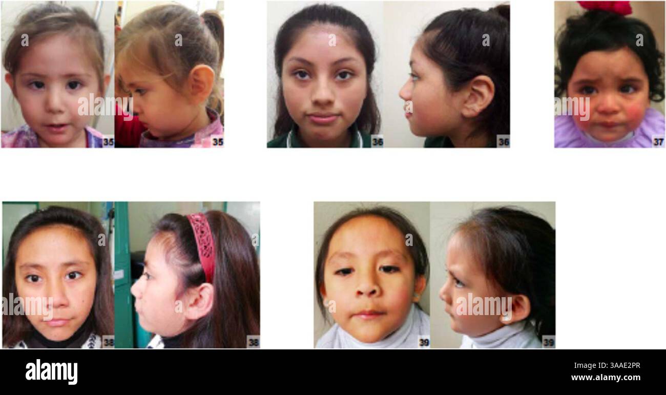 Individuen lateinamerikanischer Herkunft mit Turner-Syndrom. Stockfoto