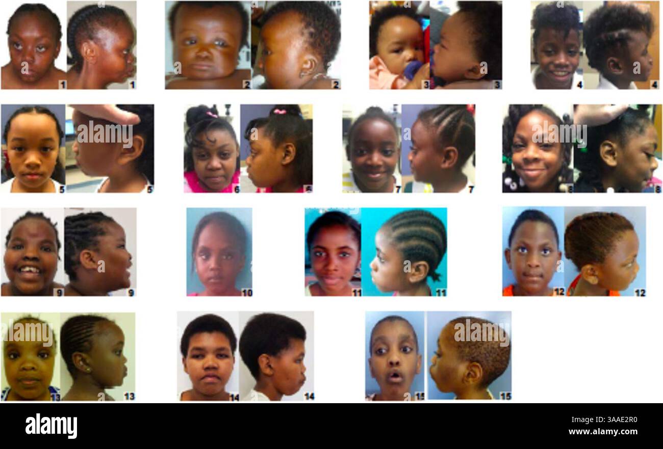 Individuen afrikanischer Herkunft mit Turner-Syndrom. Stockfoto